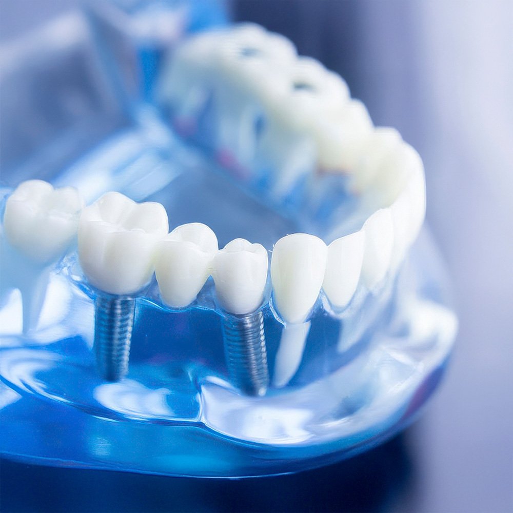 Implantes de Sirconia